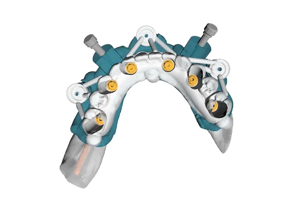 cirugia-guiada-arcada-completa-niumguide