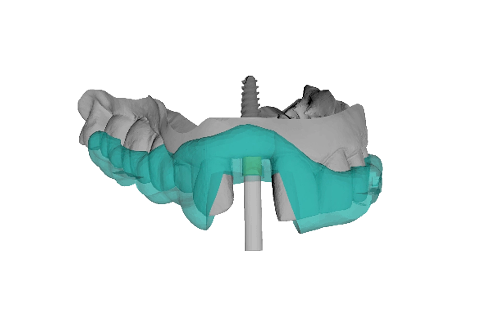 cirugia-guiada-niumguide-unitarios