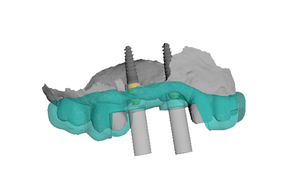 cirugia-guiada-puentes-niumguide