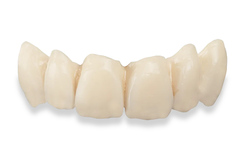 corona-circonio-sobre-diente-protesis-fija(1)