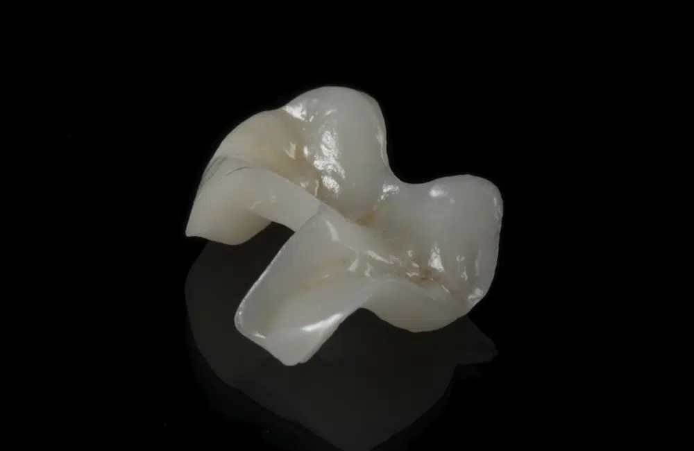 incrustaciones-esteticas2