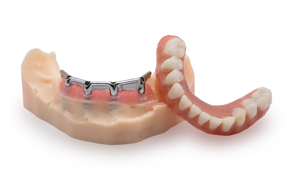 sobredentadura-sobre-barra-ackerman-removible(1)