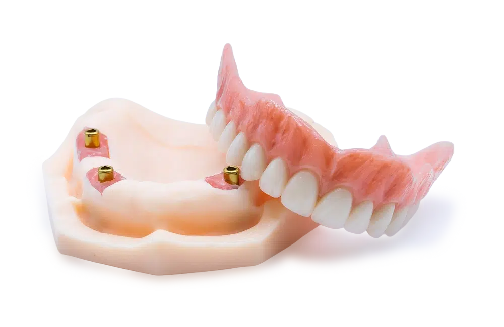 sobredentadura-sobre-locator-removible(3)