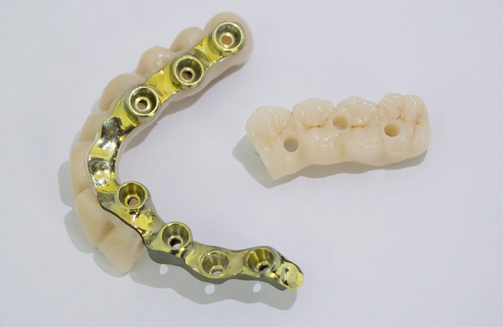 corona-circonio-cobre-implante-protesis-fija