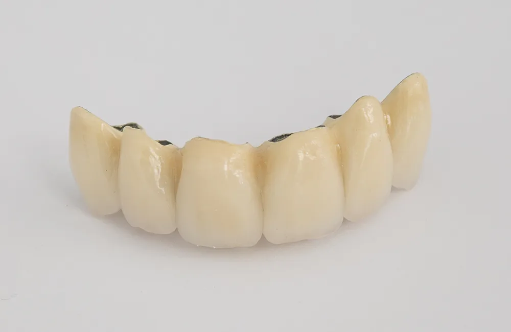 corona-metal-ceramica-sobre-diente