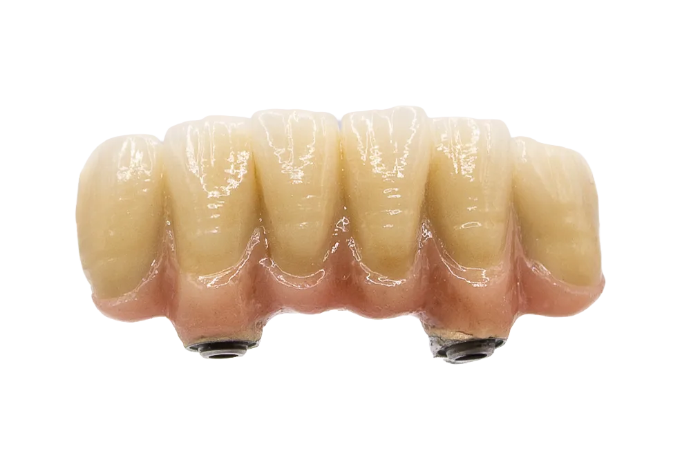 corona-metal-ceramica-sobre-implante-protesis-fija