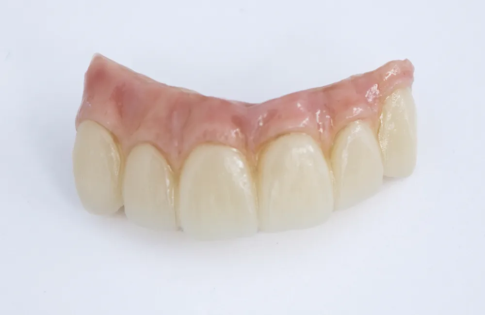 protesis-hibrida-composite-fresado-protesis-fija