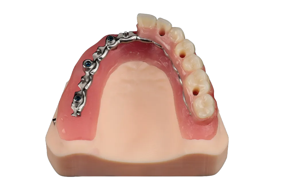 protesis-hibrida-resina-protesis-fija