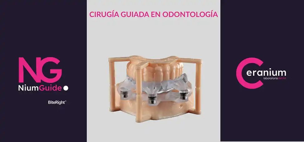 ¿Qué es la cirugía guiada en implantología?